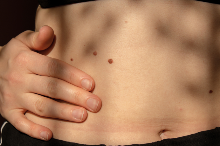 что делать, если содрал родинку