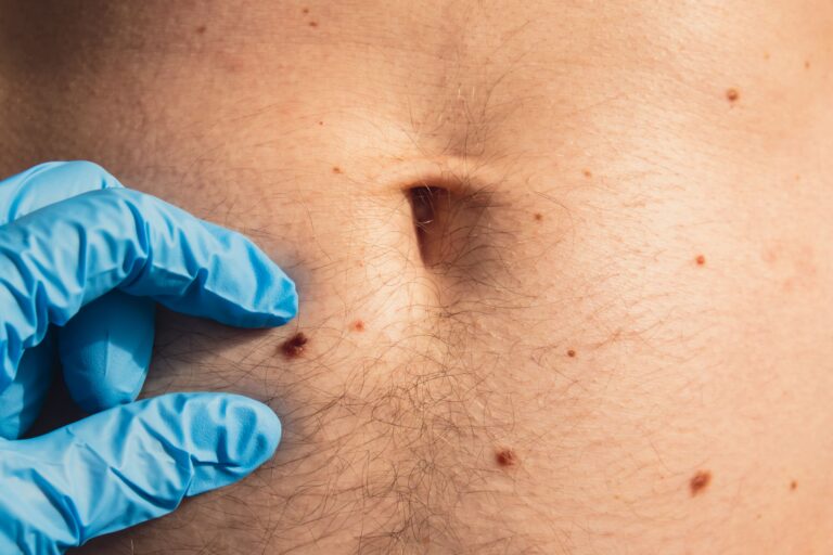 що таке папілома