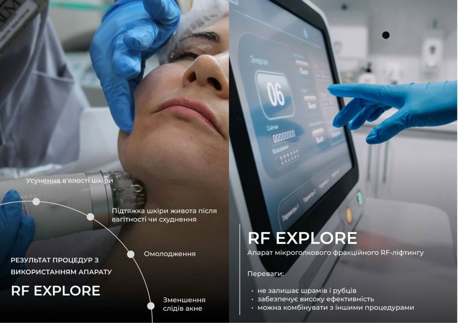 мікроголковий рф